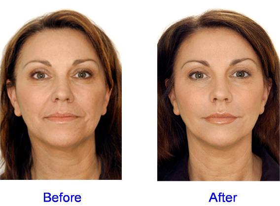 Before and After fillers