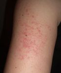 Keratosis_pilaris_arm