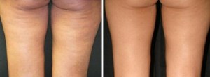No, this is NOT me, but this shows how effective the Venus Freeze can be in reducing the appearance of cellulite.