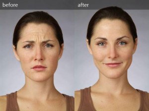 botox-before-and-after