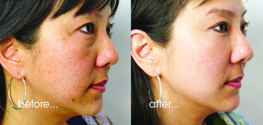 The-Perfect-Peel-before-and-after